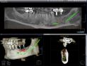 3 Boyutlu Dental Volumetrik Tomografi