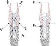 3. jenerasyon abutment Perfect Fit